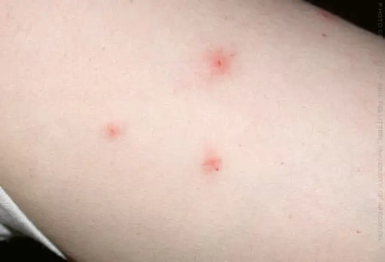 Kousance od štěnice