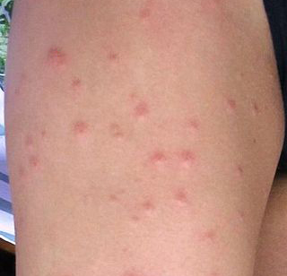 Proč komáří štípance svědí?